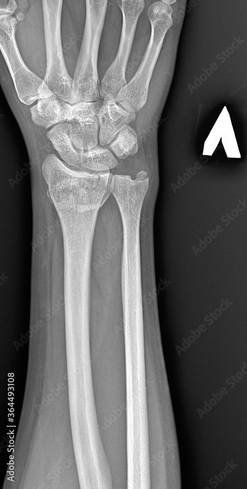X-rays of a broken arm. Human Anatomy, image of a bone injury with displacement