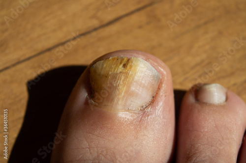 Closeup of a fungal nail