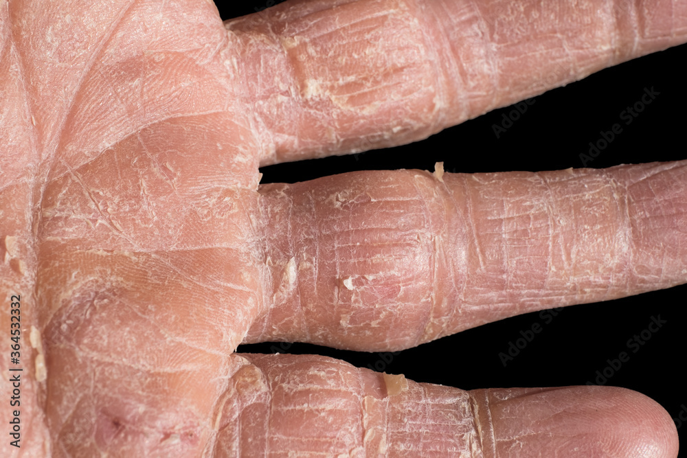 Eczema with redness, swellings, bumps and flakes on the hand and fingers of a man. This can be