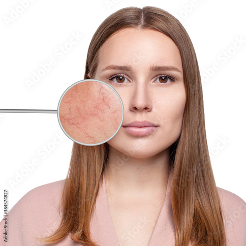 Magnifying glass shows facial skin before and after couperose treatment.