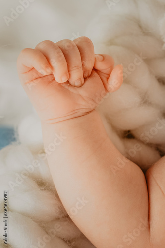 Tableau sur toile Polydactyly which is a congenital limb malformation on a newborn baby with six f