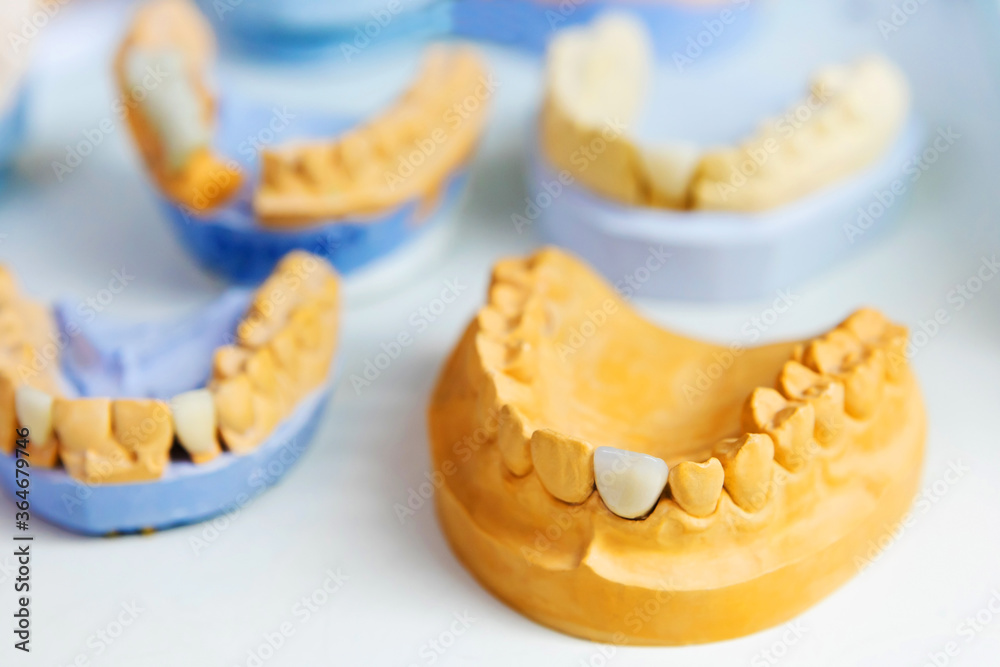 The layout of the jaw of a person with dental implants. Manufacturing and prosthetics of teeth. Dental laboratory. The layout of the jaw of a person with dental implants. Manufacturing and prosthetics of teeth. Dental laboratory.