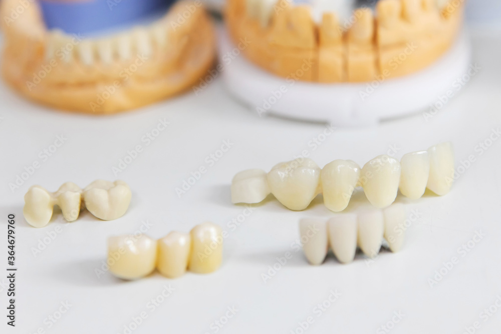 White dental crowns on the table at the dentist. Making dentures. Close-up plan. View from above. White dental crowns on the table at the dentist. Making dentures. Close-up plan. View from above.