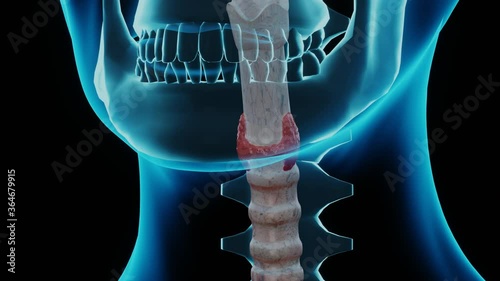 Nodular goiter in human body. 3D render animation of tissue problem, health issue. Health disorder dysfunction