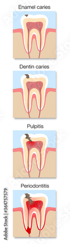 caries, development, infographic, stages, cross section, tooth decay, enamel, dentin, pulpitis, periodontitis, anatomy, toothache, abscess, dentistry, dental, diagram, inflammation, chart, care, healt