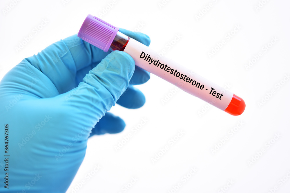 Fototapeta premium Test tube with blood sample for dihydrotestosterone or DHT hormone test
