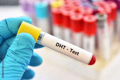 Test tube with blood sample for dihydrotestosterone or DHT hormone test