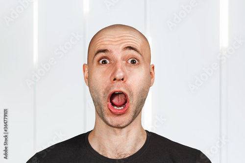 Confused young bald man with alopecia. guy skin head with hair loss want transplant with open mouth