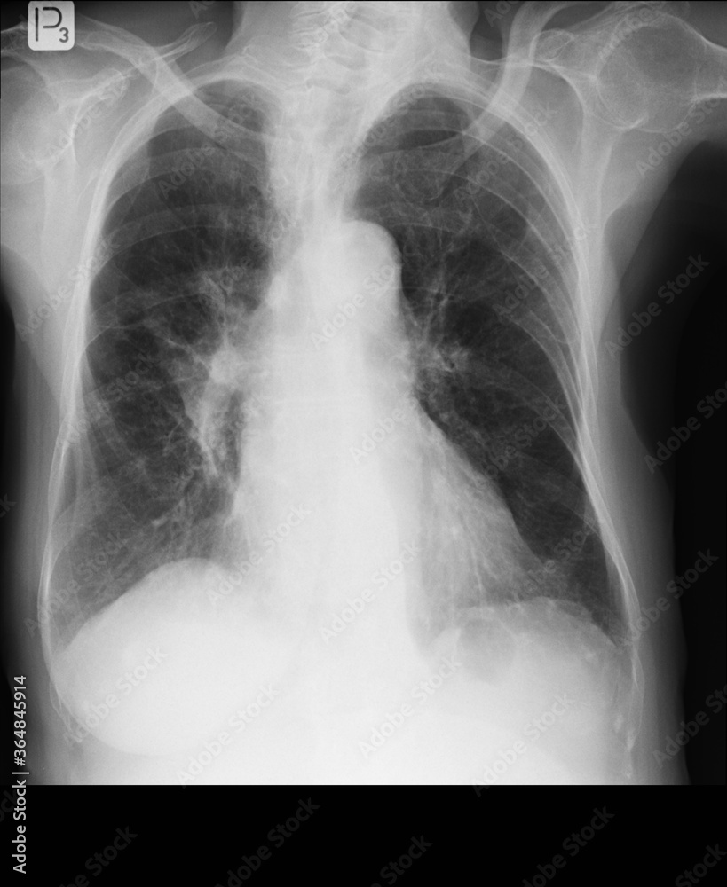 Chest x-rays durring lungs Tuberculosis also called as MTB or TB Chest x-rays durring lungs Tuberculosis also called as MTB or TB