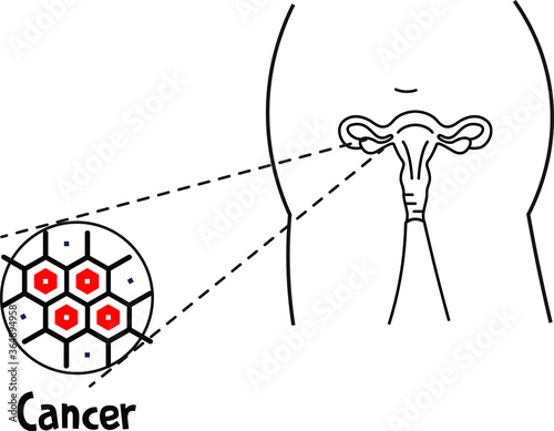 Illustration of Ovarian cancer ovary cyst cancer cells enlarged in microscope view zoom in