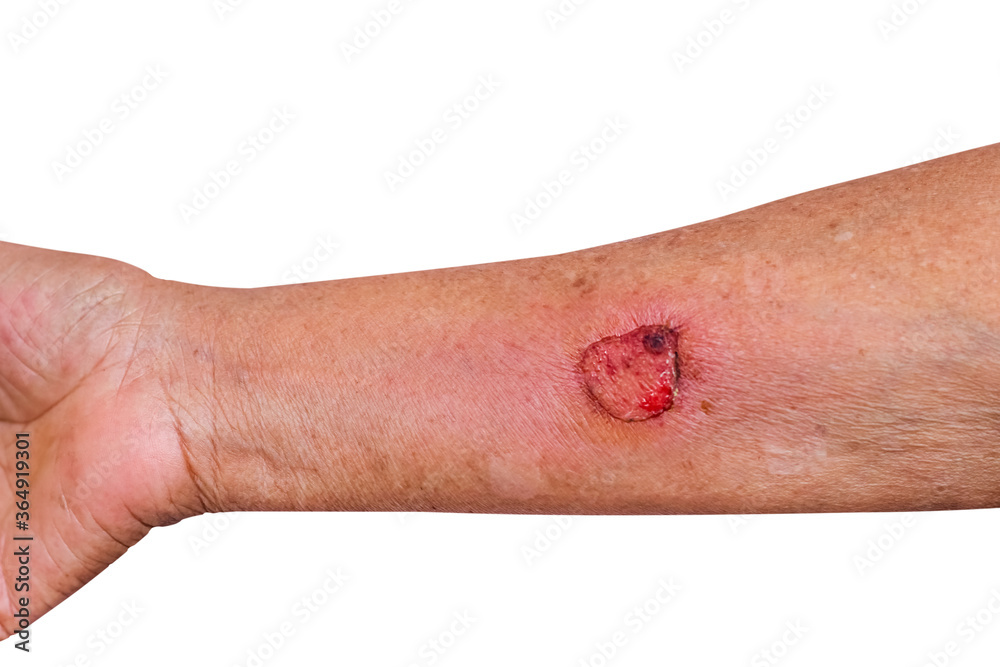 Wound was hot water scalded and Inflammation on elderly woman arm isolated on white background , clipping path Wound was hot water scalded and Inflammation on elderly woman arm isolated on white background , clipping path