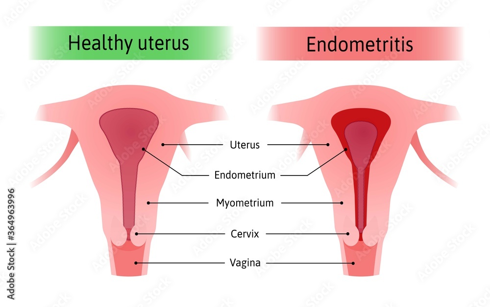 Endometritis or inflammation of the inner lining of the uterus ...