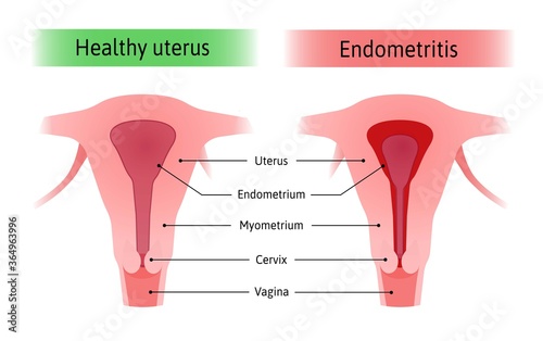Endometritis or inflammation of the inner lining of the uterus endometrium. Normal healthy uterus and inflammed endometrium. Mediacal vector illustration marked with lines photo