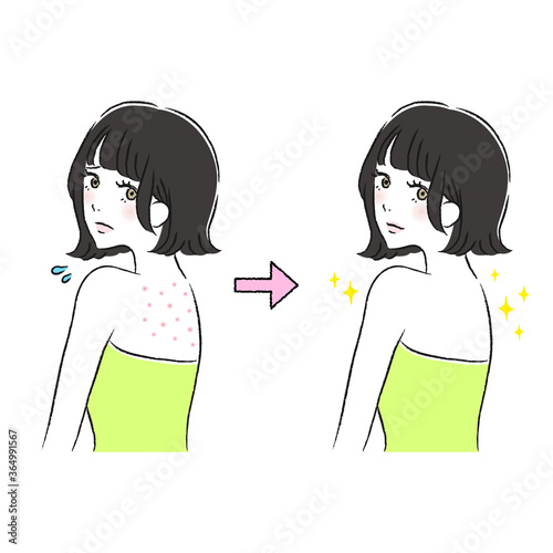 背中　にきび　ケア