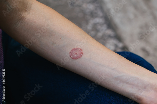 Ring Worm infection, Dermatophytosis on skin. Applying an emollient to dry flaky skin