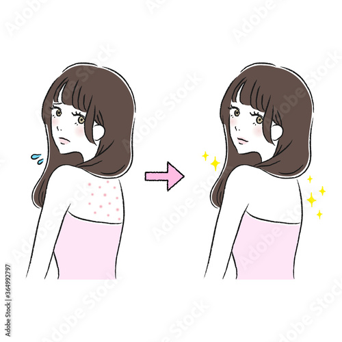 背中　にきび　ケア