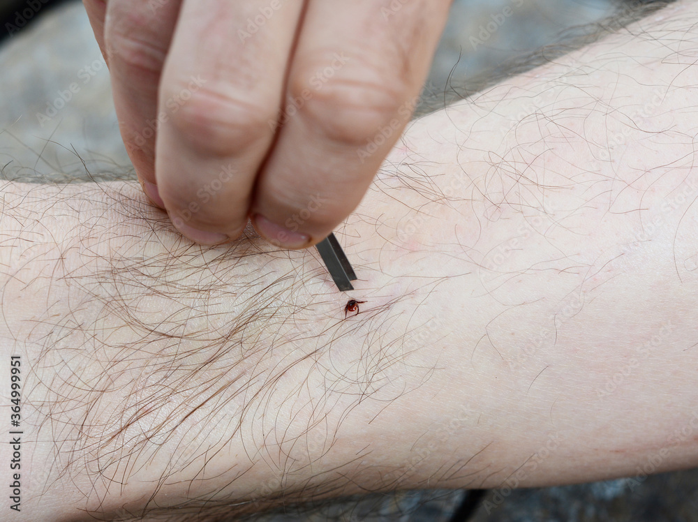 Fotografie Removing a blacklegged tick using fine pointed tweezers