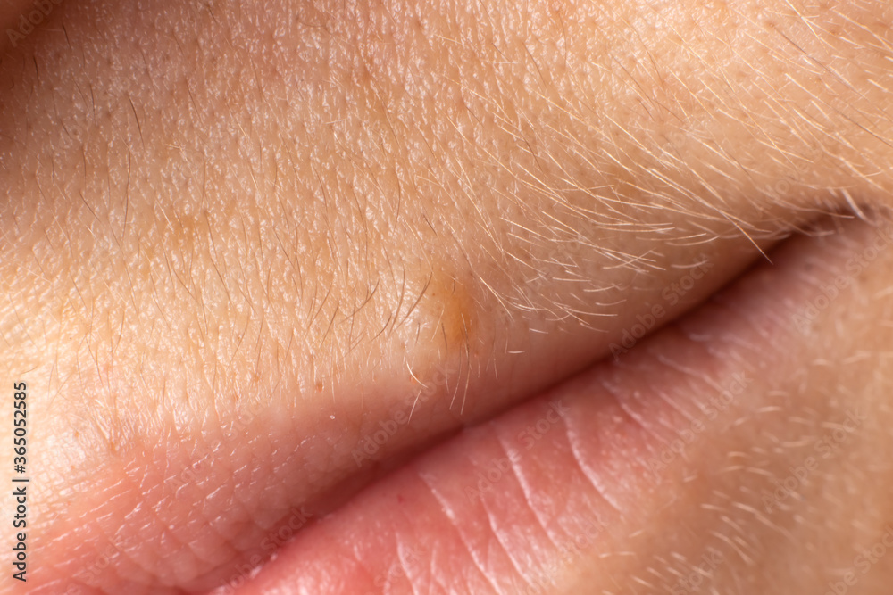 A mole near the upper lip. Nevus macro close up. Birthmark