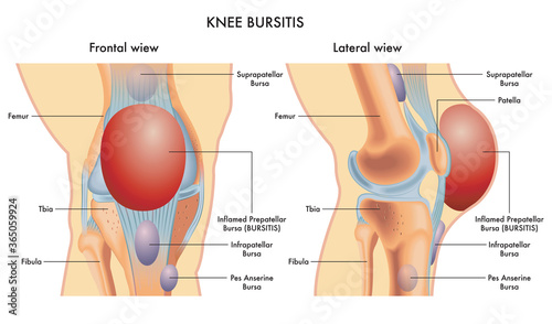 Medical illustration of a knee with an inflamed prepatellar bursa (BURSITIS) viewed frontally and laterally, with annotations. photo