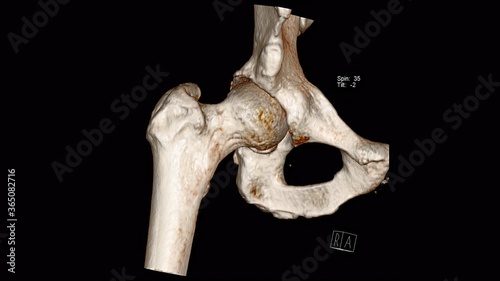 Radiology examination, Computed Tomography Volume Rendering examination of the Hip joint ( CT VR Hip)