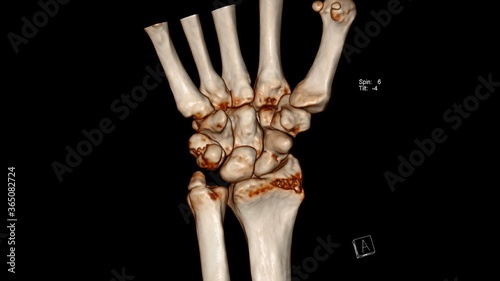 Radiology examination, Computed Tomography Volume Rendering examination of the wrist joint ( CT VR wrist) showing fracture of the scaphoid bone and ulnar styloid  photo