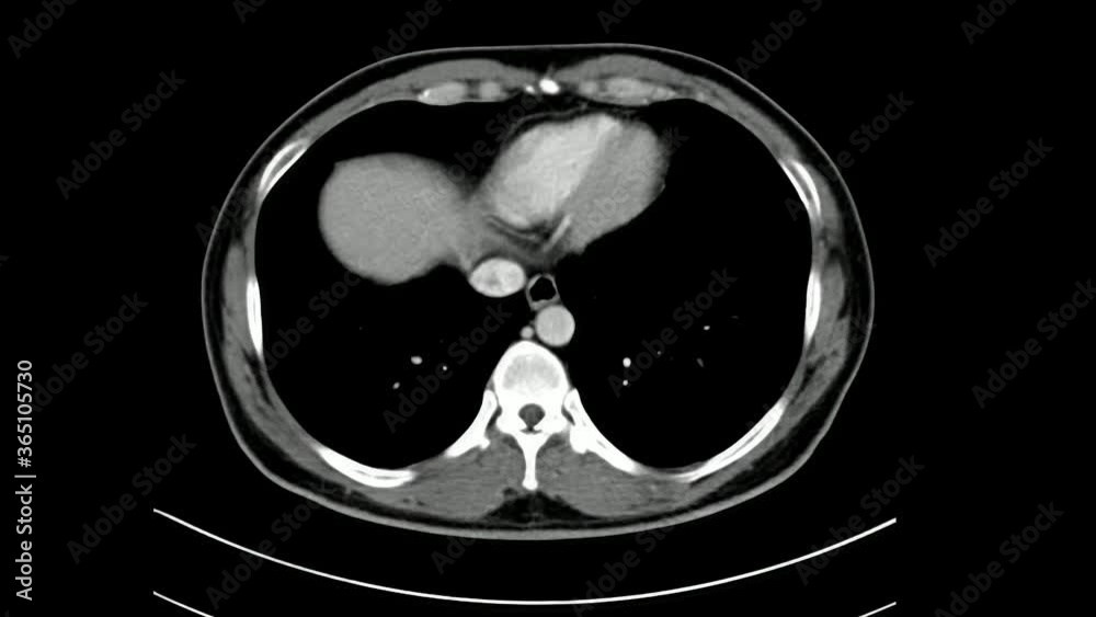 Computed Tomography scan (CT scan) of the chest, Abdomen and pelvis with oral and intravenous contrast administration axial plane in a male patient for diagnosis of malignancy