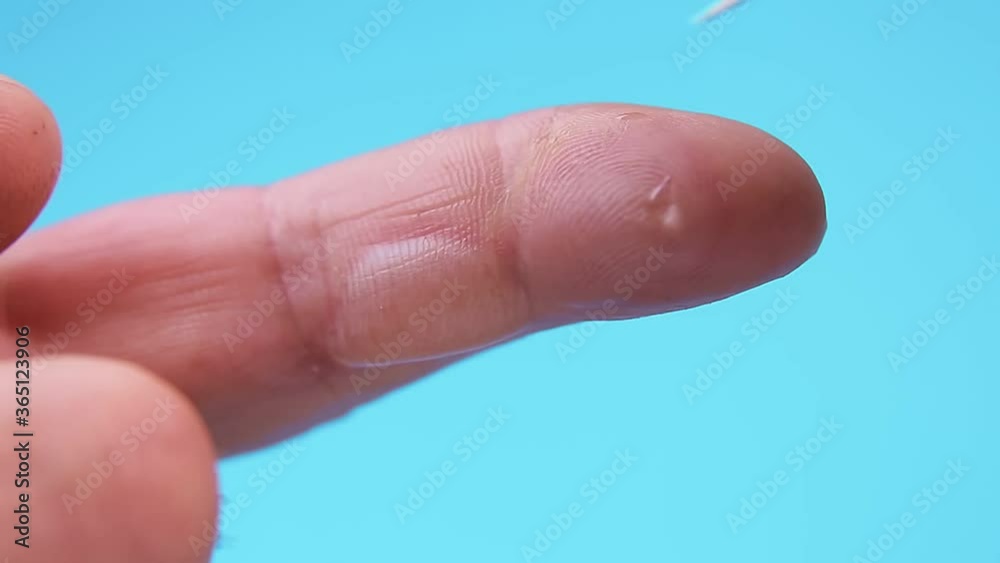 a burn on the fingers of a hand is pierced and a fluid comes out a burn on the fingers of a hand is pierced and a fluid comes out