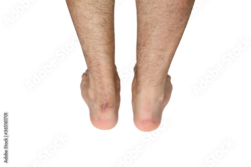 Operation scar of Achilles tendon rupture. White isolated.