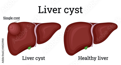 Illustration of a healthy liver and single liver cyst