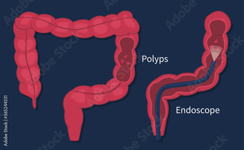 Flat vector illustration of colorectal cancer screening on dark background. Removing polyps procedure. Colonoscopy endoscopic examination of the large bowel.
