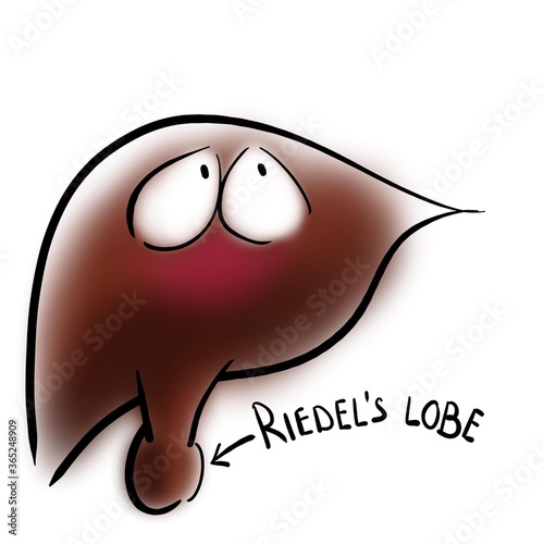 Riedel's lobe of the liver photo