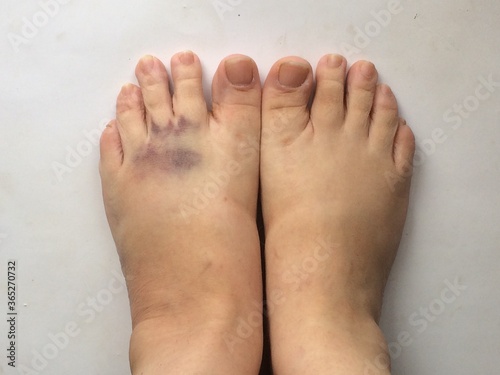 Bruise on the foot, contusion, dislocation of the foot, edema, medicine