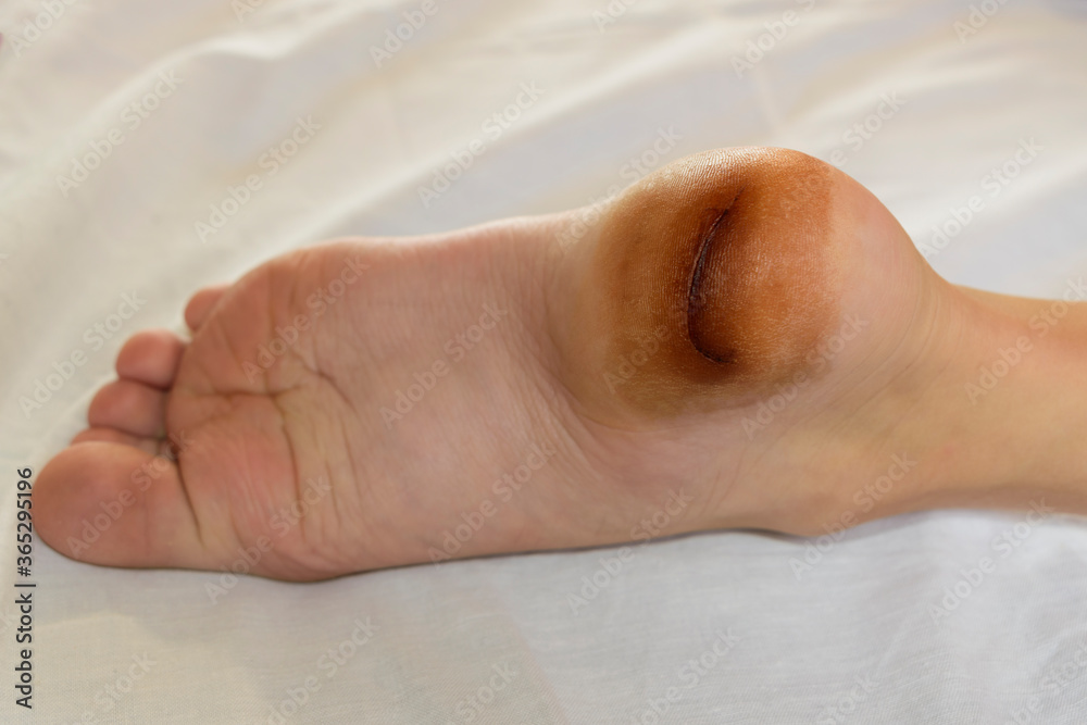 Heel injury. Child's leg cut. Concept of being injured by glass or metal while swimming. Heel injury. Child's leg cut. Concept of being injured by glass or metal while swimming.
