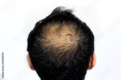 male person lost his top hair,  starting to get bald