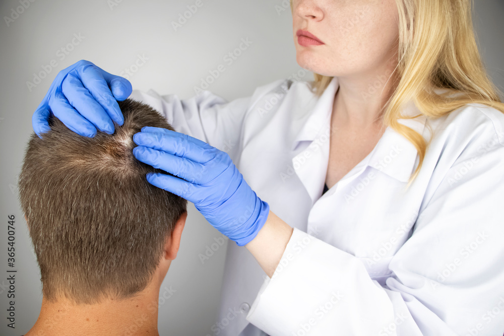 A trichologist examines the hair of a man who begins alopecia. Consultation with a dermatologist. Hair loss, alopecia, pruritus, burning head or seborrhea A trichologist examines the hair of a man who begins alopecia. Consultation with a dermatologist. Hair loss, alopecia, pruritus, burning head or seborrhea