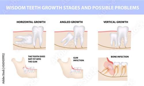 possible problems due to wisdom tooth
