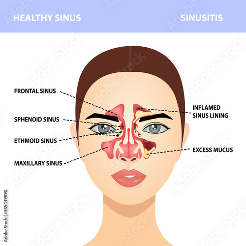 Sinusitis. Healthy and sinus infections, signs, realistic illustration for medical posters and educational materials