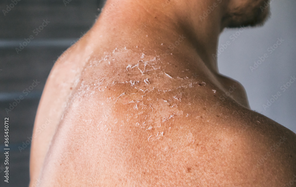 The dry and itching man's skin after sunbath The dry and itching man's skin after sunbath