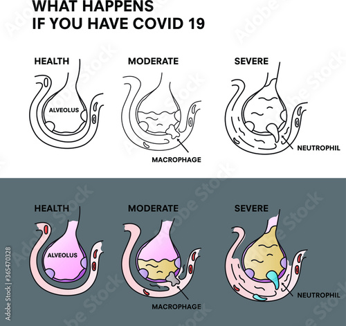 Coronavirus 2019-nCoV Infographic, What happens if you have Covid 19.  Virus or bacterial infects lungs. Virus invades alveoli.
Structure of alveolus of human lungs with Corona.