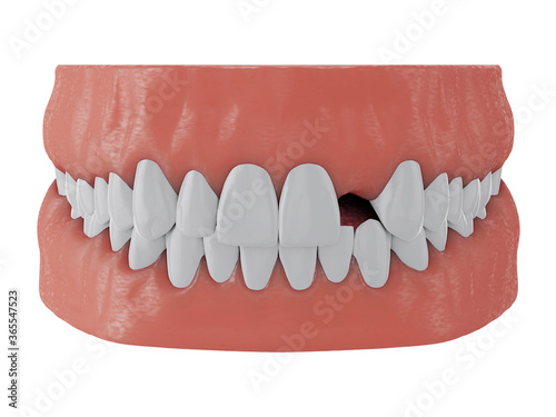 jaw with missing front tooth deuce on white background, 3d render