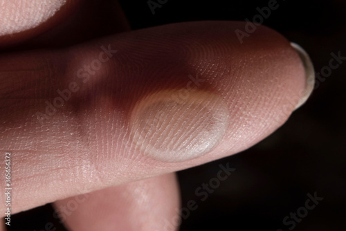 Big callus on a woman s finger. The woman twisted the fabric for a long time and now she has a callus on her finger