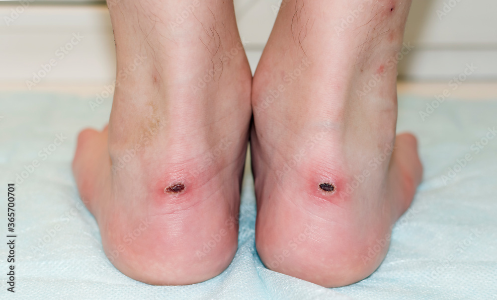 Calluses on the ankles with sores. Bare feet with a dermatological problem. Dried blood on the ankle. Calluses on the ankles with sores. Bare feet with a dermatological problem. Dried blood on the ankle.