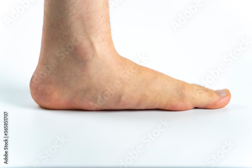 An advanced flat feet (pes planus or fallen arches) medical condition photo