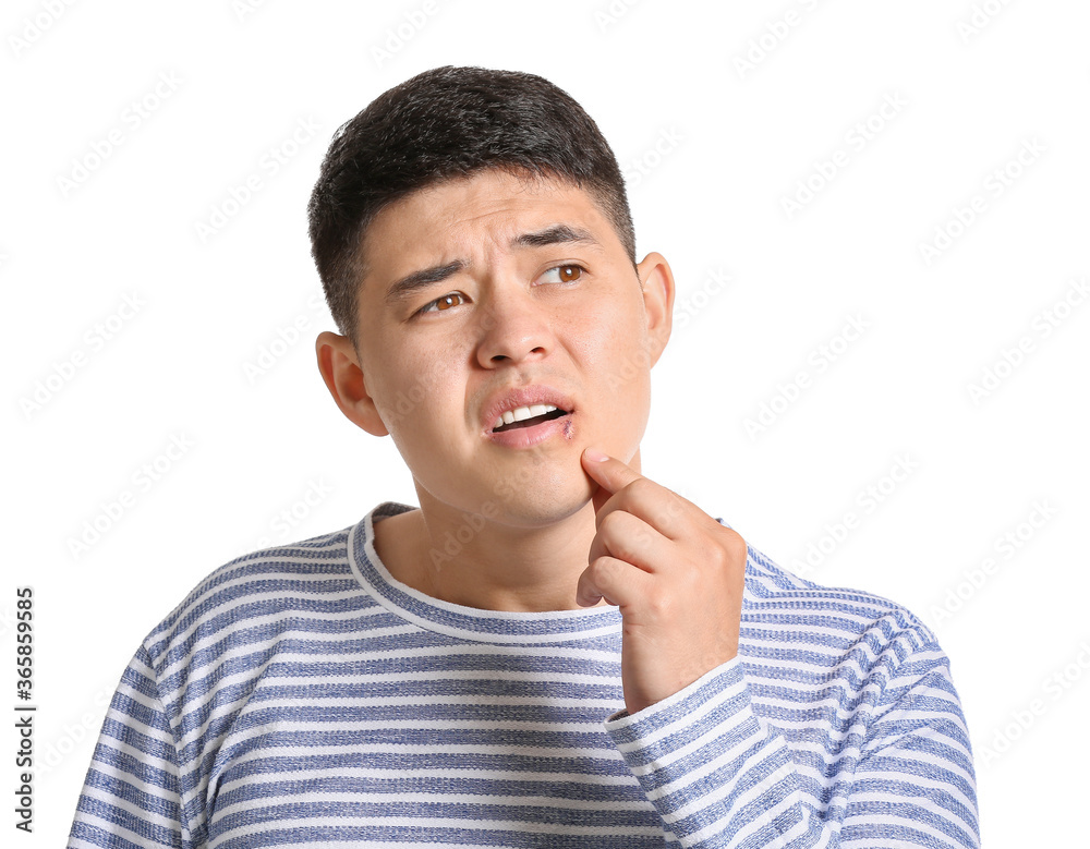 Asian man with cold sore on white background Asian man with cold sore on white background