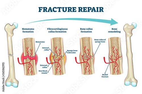 Fracture repair as educational bone remodeling formation vector illustration