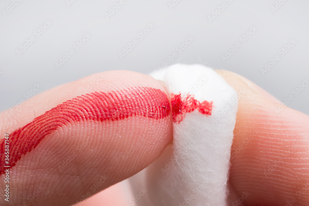 Fototapeta premium Use a cotton wool to wipe the blood at the wound on fingertips that are bleeding.