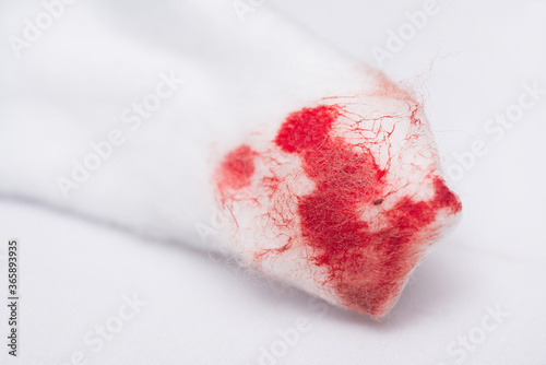 Bilde på lerret A cotton wool swab with blood stains after use, from cleansing the bleeding wound on a white background