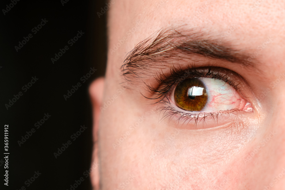 Close up mans bloodshot or red eyes on a black background, caused by conjunctivitis, allergy or tiredness . Concept of healthcare with copy space Close up mans bloodshot or red eyes on a black background, caused by conjunctivitis, allergy or tiredness . Concept of healthcare with copy space