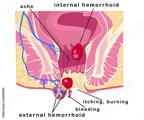 hemorrhoids, internal and external hemorrhoid node, hemorrhoid symptoms, anus, medica, vector stock illustration, place text, isolated on white background