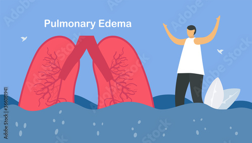 Pulmonary edema is symptom that lungs fill with fluid. Other names is lung congestion, lung water, and pulmonary congestion. ฺBody struggles to get enough oxygen until shortness of breath.